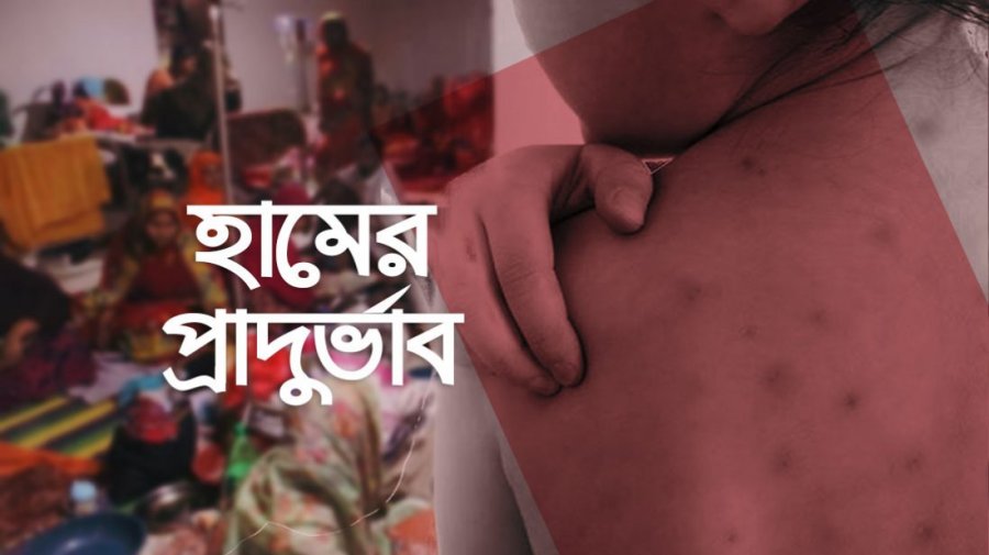 হাম ও হামের উপসর্গে আরও ১১ জনের মৃত্যু
