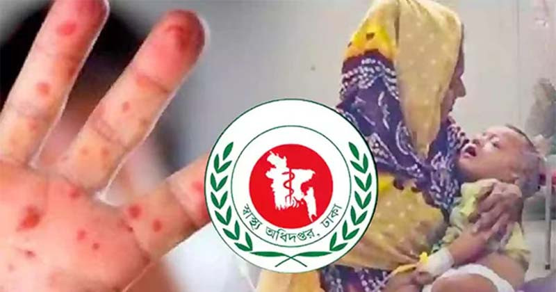 হাম উপসর্গে আরও ৮ জনের মৃত্যু